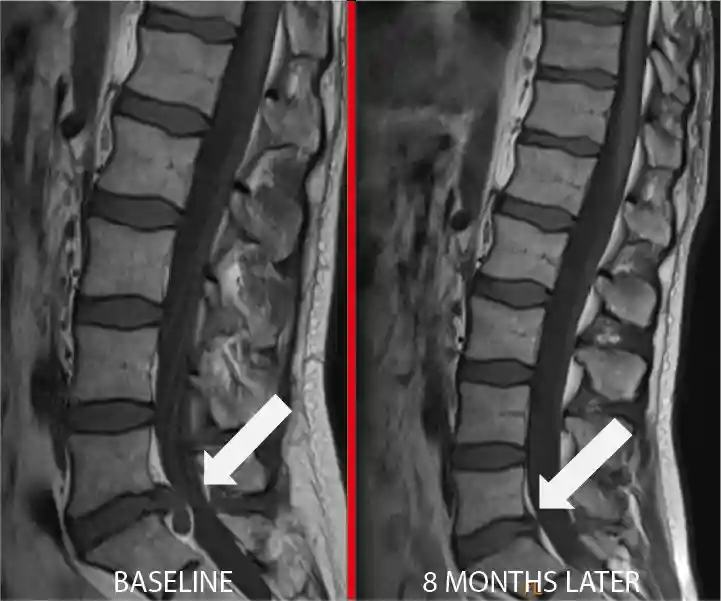 Lower Back Pain Case – MRI of L5-S1 Disc Herniation