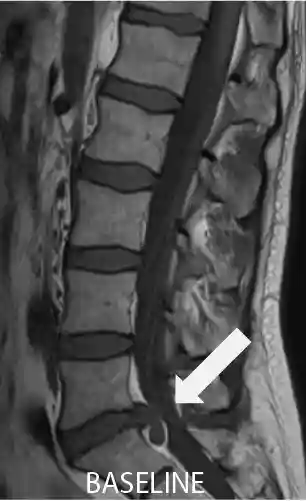 MRI scan showing lumbar disc prolapse at L5-S1 before physiotherapy