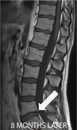 L5-S1 Disc Herniation – MRI After Successful Conservative Therapy