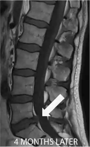 MRI image showing treatment progress of L5-S1 disc herniation